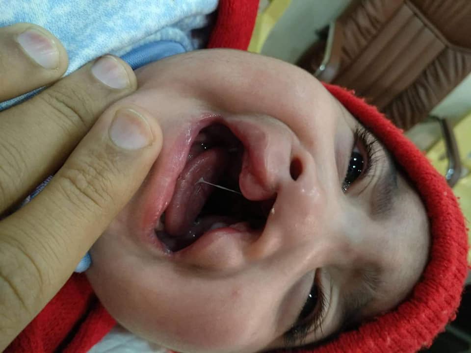 عملية جراحية ناجحة لطفل يعاني من شق اللهاة و الشفة (شفة الارنب)