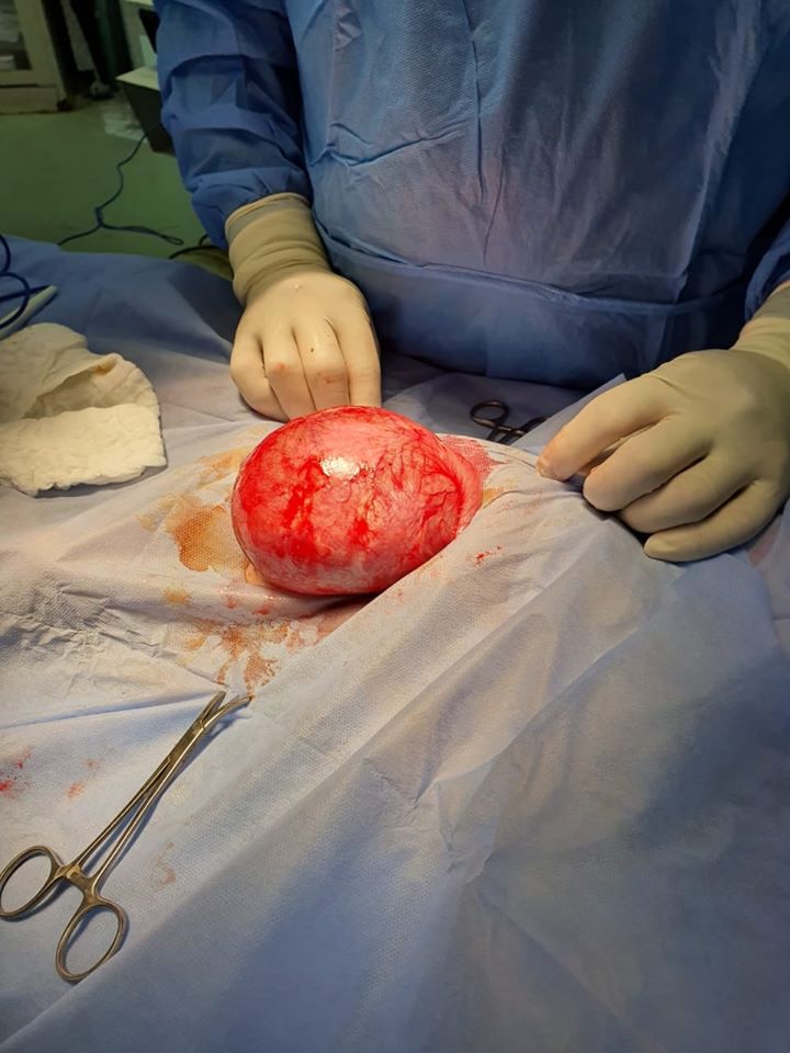 عملية جراحية لرفع كيس كبير جدا من جوف طفلة بعمر 40 يوم