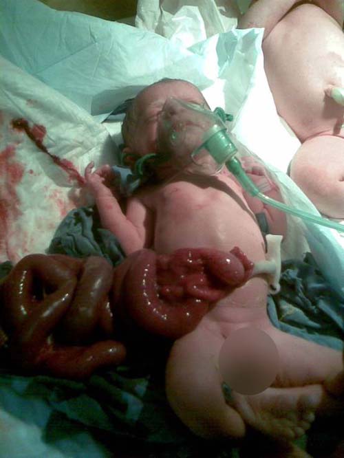 ولادة مشوهة الامعاء في مستشفى المناذرة العام